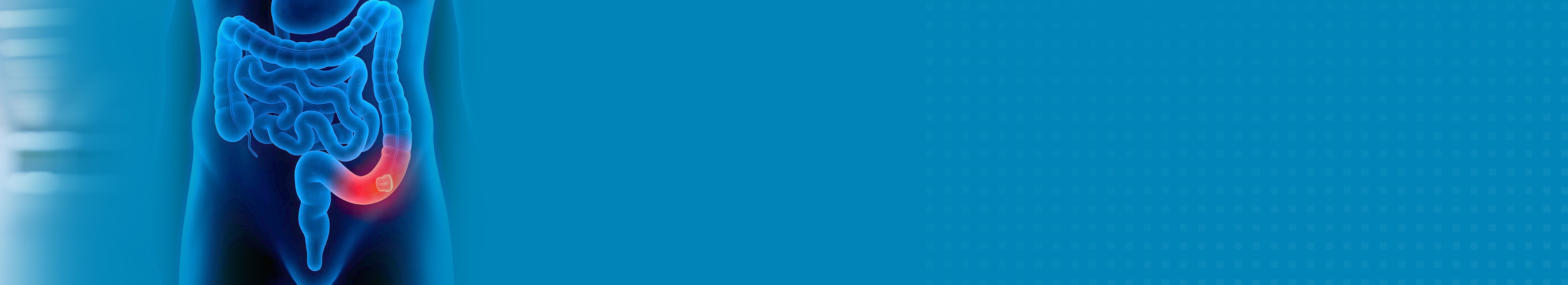Best Hospital For Colon Cancer Treatment