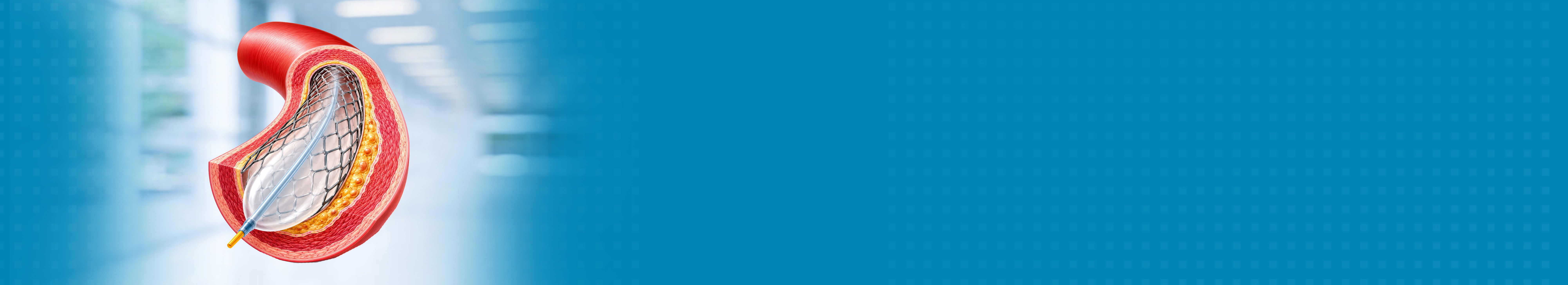 Best Coronary Angioplasty Surgery Hospital