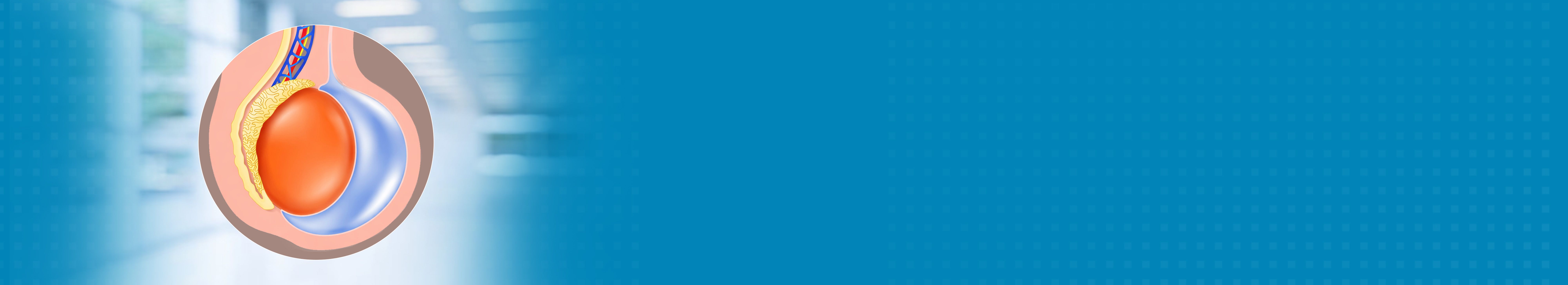Best Hydrocele Treatment Hospital