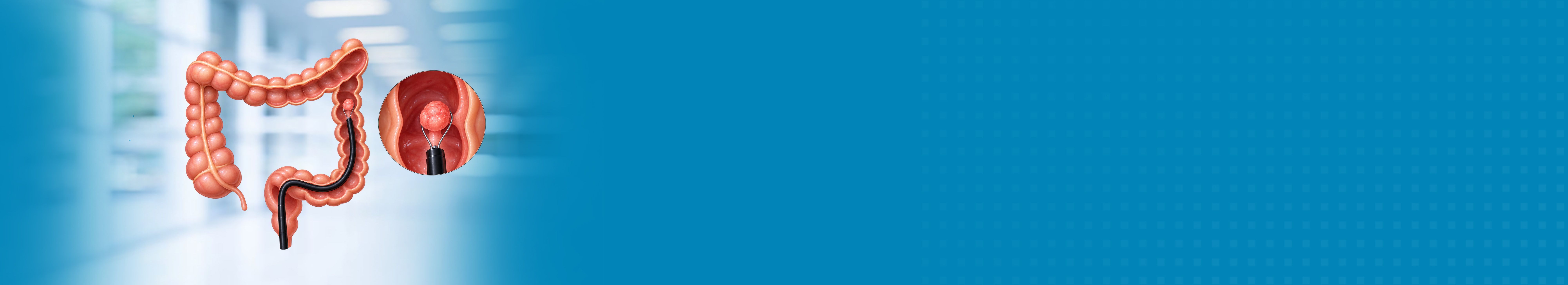 Best Hospital for Polypectomy Treatment