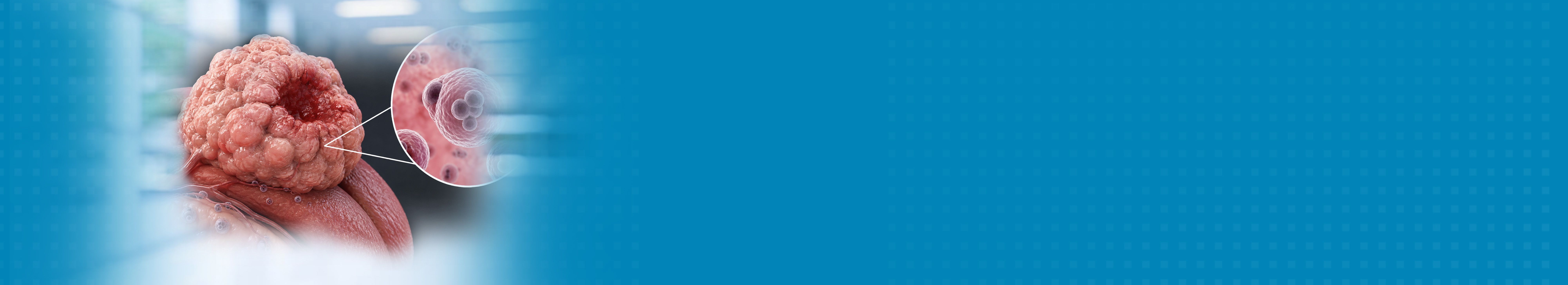 Best Hospital For Verrucous Carcinoma Treatment