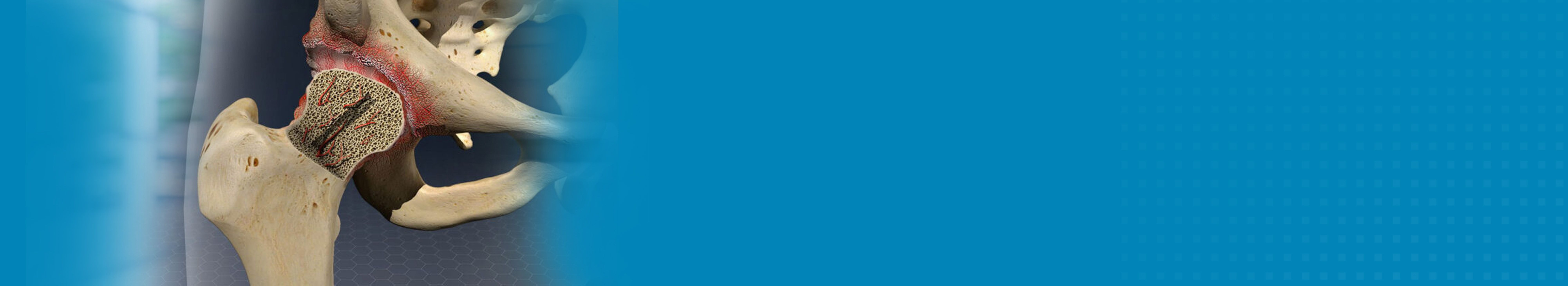 Best Hospital For Avascular Necrosis Treatment