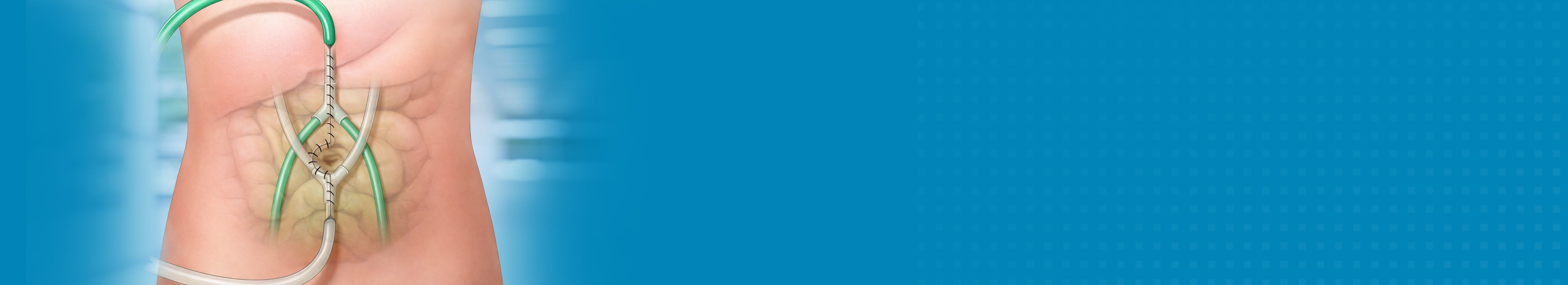 Best Hospital For HIPEC Surgery