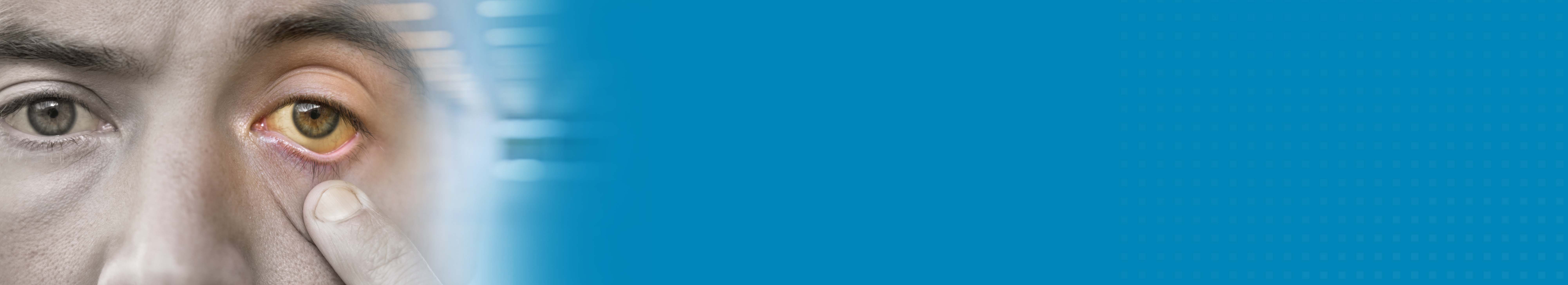 Best Hospital for Jaundice Treatment