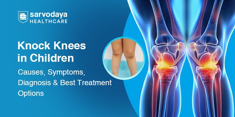 Knock Knees in Children: Causes, Symptoms, Diagnosis & Best Treatment Options