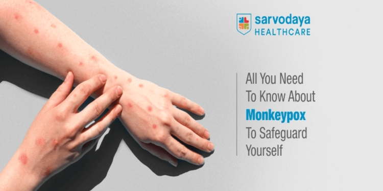 All You Need to Know About Monkeypox to Safeguard Yourself