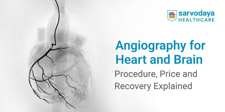 Angiography for Heart and Brain: Procedure, Price and Recovery Explained