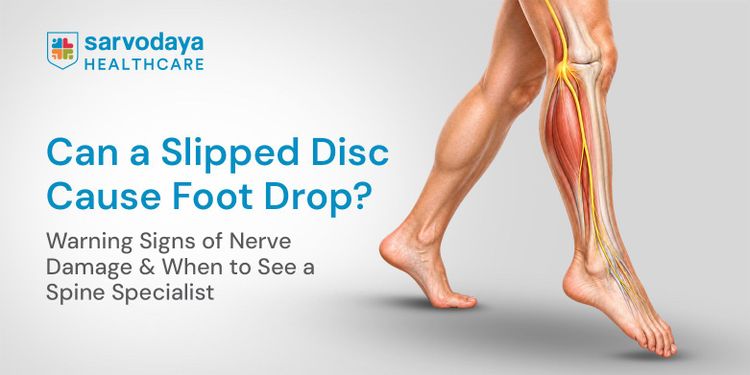 Can a Slipped Disc Cause Foot Drop? Warning Signs of Nerve Damage & When to See a Spine Specialist