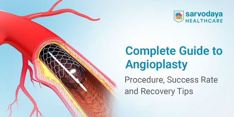 Complete Guide to Angioplasty: Procedure, Success Rate and Recovery Tips