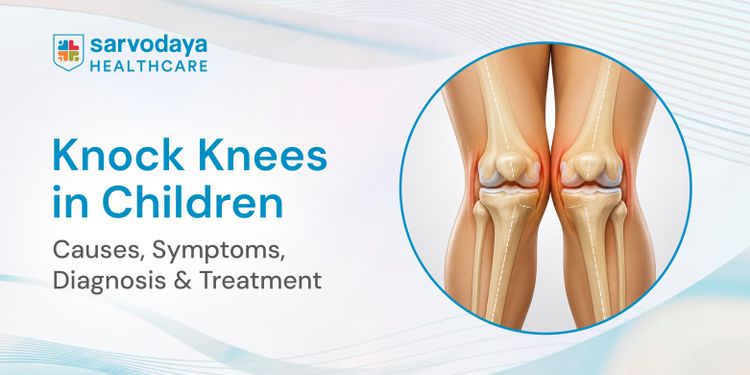 Knock Knees in Children: Causes, Symptoms, Diagnosis & Treatment