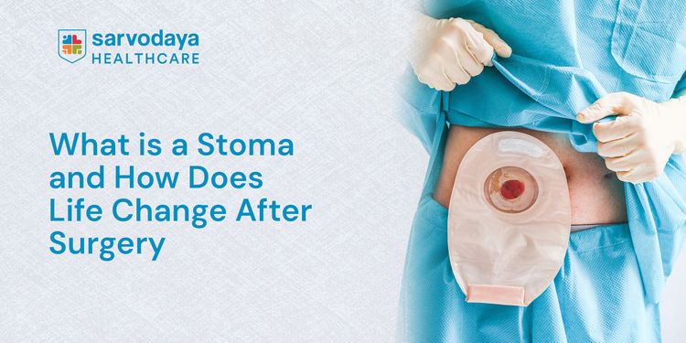 What is a Stoma and How Does Life Change After Surgery?