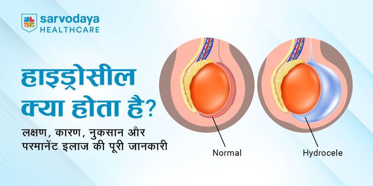 हाइड्रोसील क्या होता है? लक्षण, कारण, नुकसान और परमानेंट इलाज की पूरी जानकारी