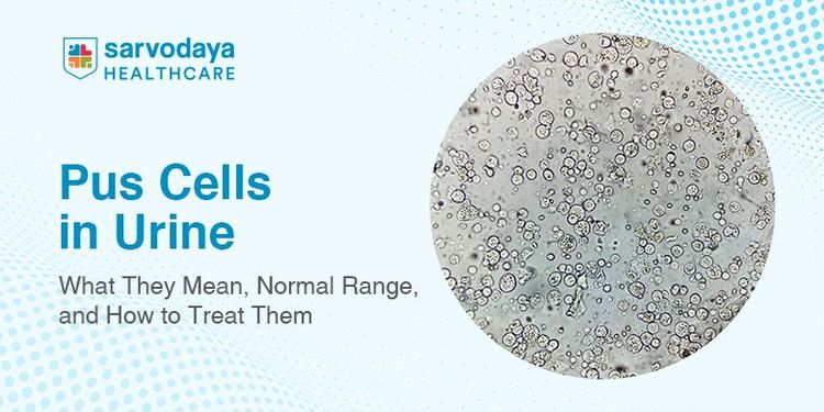 Pus Cells in Urine: What They Mean, Normal Range, and How to Treat Them