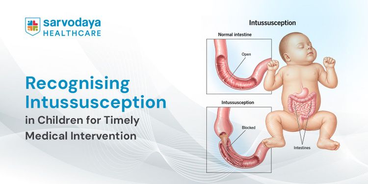 Recognising Intussusception in Children for Timely Medical Intervention
