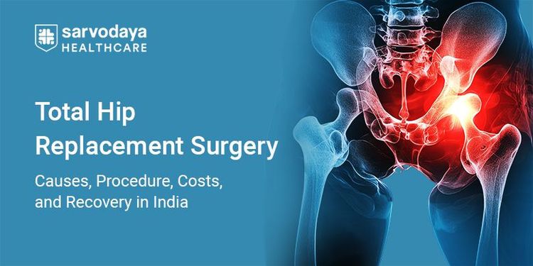 Total Hip Replacement Surgery: Causes, Procedure, Costs, and Recovery in India