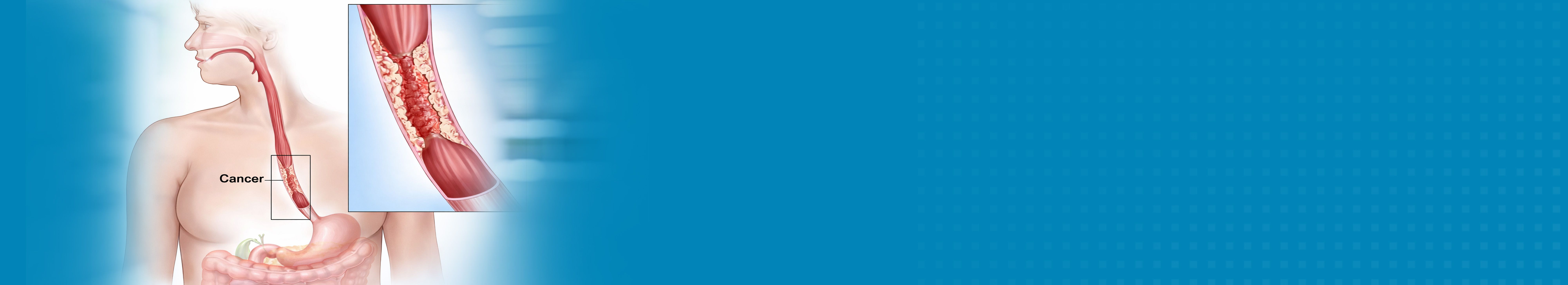 Best Hospital For Minimally Invasive Oesophageal Cancer Surgery