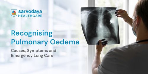 Recognising Pulmonary Oedema: Causes, Symptoms and Emergency Lung Care