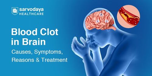 Blood Clot in Brain: Causes, Symptoms, Reasons & Treatment