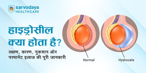 हाइड्रोसील क्या होता है? लक्षण, कारण, नुकसान और परमानेंट इलाज की पूरी जानकारी