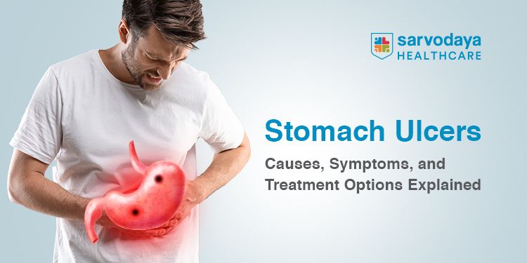 Stomach Ulcers: Causes, Symptoms, and Treatment Options Explained