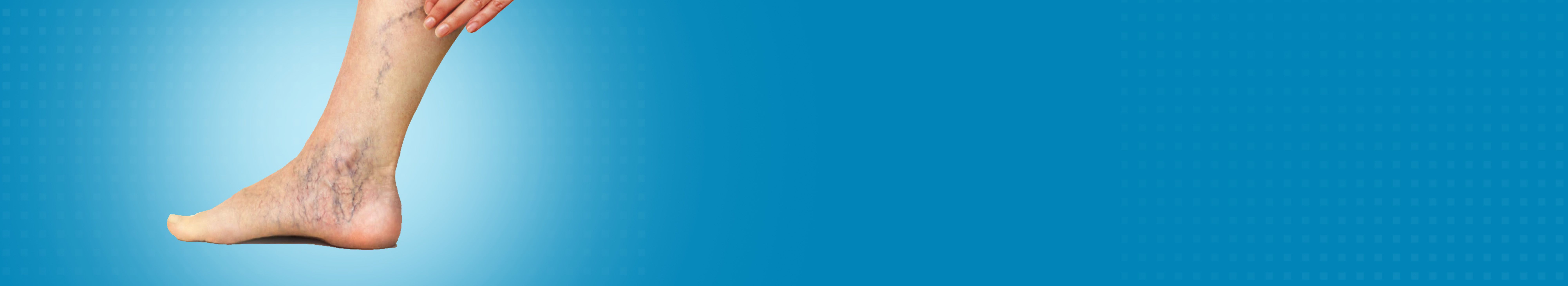 Best Hospital for Varicose Veins Treatment